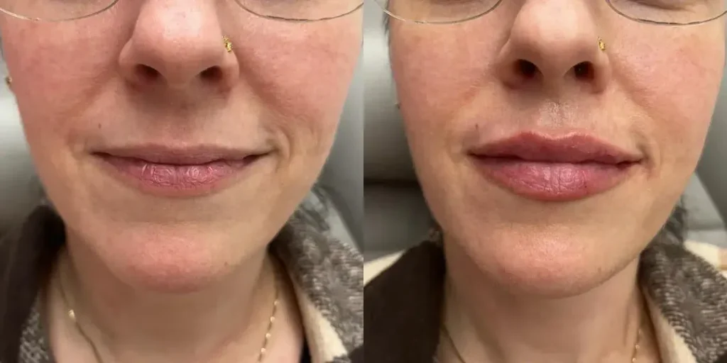 Lip Filler Treatment near me ,Best Med Spa in NY