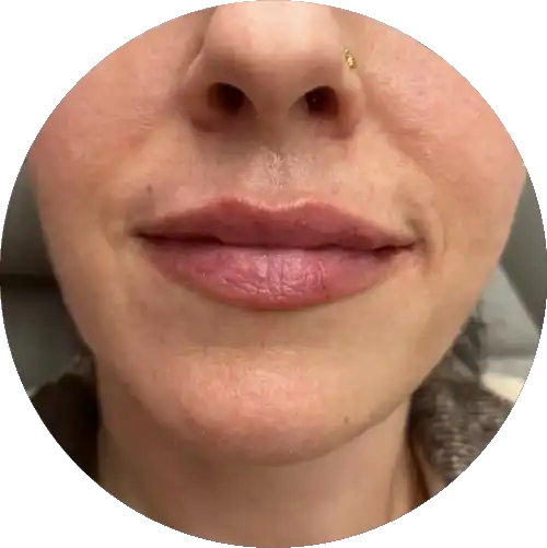 Patient Lip Filler