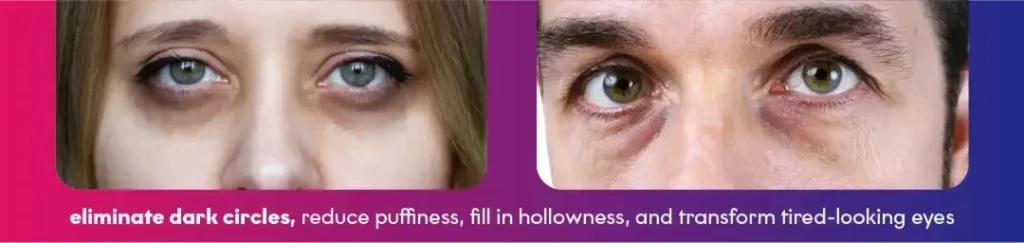 Lip Filler Treatment near queens,NY USA